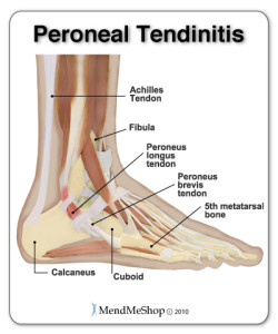 peroneal-tendinitis-tendonitis